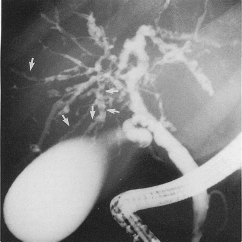 Endoscopic Retrograde Cholangiopancreatography Performed On Apatient