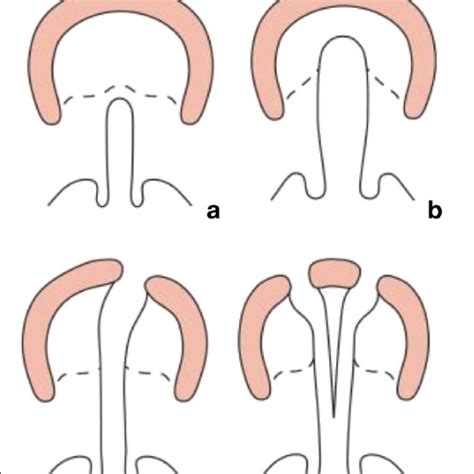 Lahsal System For The Classification Of Cleft Lip And Palate Download