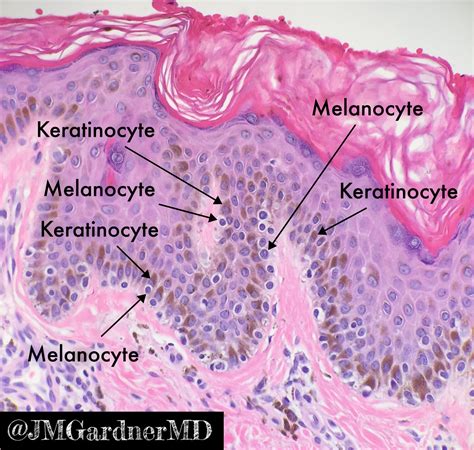 Melanocytes Vs Keratinocytes Made Easy 5 Minute Pathology Pearls Kiko Xp