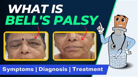 Bells Palsy What You Need To Know About Facial Paralysis Homoeocare
