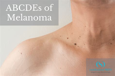 Cumberland Dermatologist Explains The Abcdes Of Melanoma
