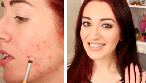 How To Cover A Pimple And Mild Acne Scarring Makeup