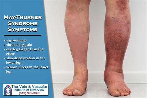 This Iliac Vein Compression In The Legs Is A Vein Disease Known As May