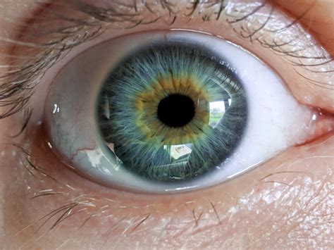 Central Heterochromia Eyes