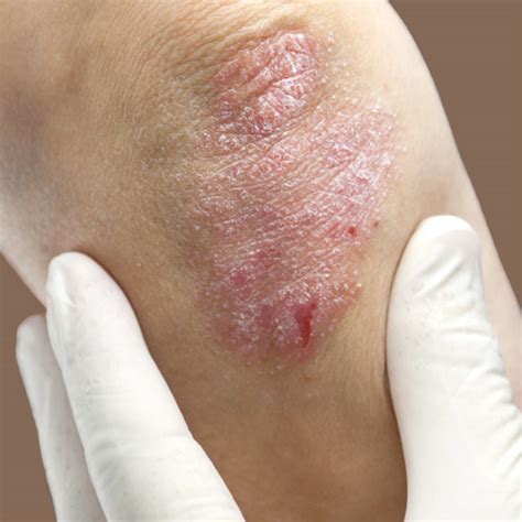 Improve Dermatology Skills Skin Diseases And Conditions Cme Course Cme