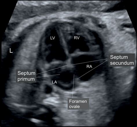 Cardiac Chambers The Four Chamber And Short Axis Views Obgyn Key Medical Ultrasound