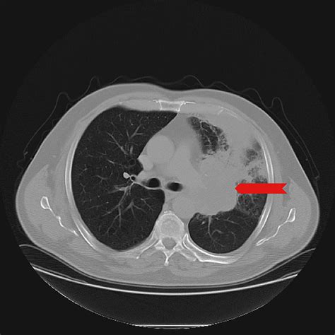 Ct Scan Images Of Lung Cancer Hot Sex Picture