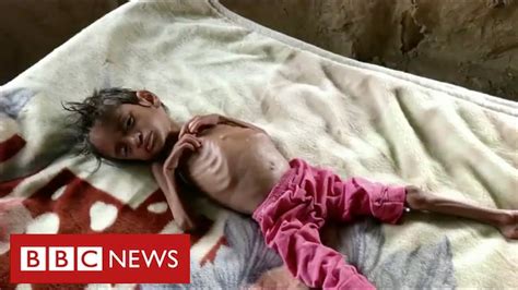 Millions Of Children Face Starvation In Yemen Warns United Nations