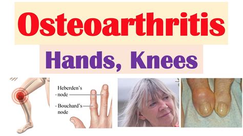 Osteoarthritis Arthritis Of Hands Knees Causes Risk Factors