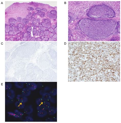 Representative Features Of Case 2 Primary Gastric Follicular Lymphoma