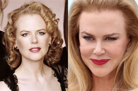 Nicole Kidman Before And After Plastic Surgery 28 Celebrity Plastic
