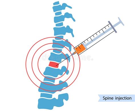 Spine Joint Injection Stock Vector Illustration Of Backbone 217138166