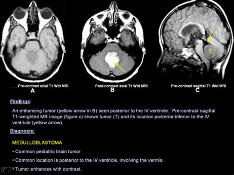 Headache As Related To Brain Tumor Children Pictures