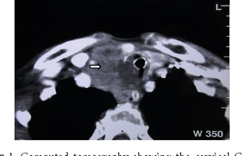 Figure 4 From Thyroid Carcinoma Showing Thymic Like Differentiation