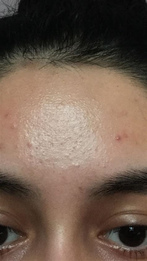 Skin Concern Is This Actual Clogged Pores And Bad Texture Or Is It