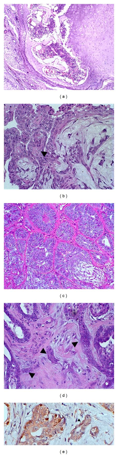 A Benign Mixed Tumor In Canine Mammary Gland Presenting Chondroid And