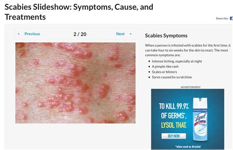 Icd 9 Code For Scabies Dermatitis