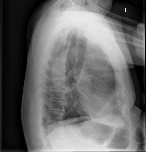 Unfolded Aorta Radiology Case Radiology Case