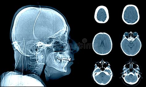 Normal Head On Ct Scans Stock Photo Image Of Human Matter 55979524