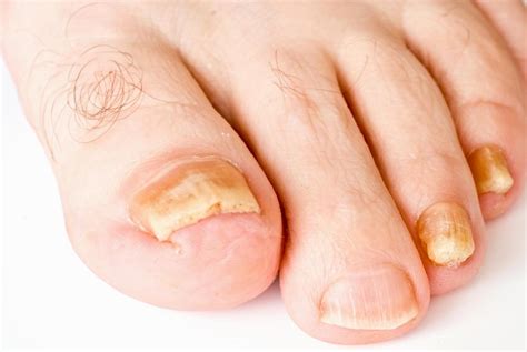 What Causes Discolored Toenails With Pictures