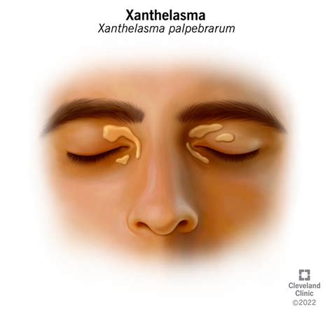 Xanthelasma What It Is Causes And Treatment