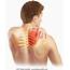 Neck Pain Upper Back Shoulder Could It Be Thoracic Outlet 