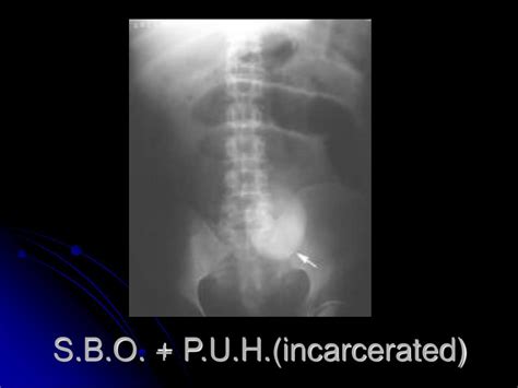 Ppt Small Bowel Obstruction Andpost Operative Ileus Powerpoint