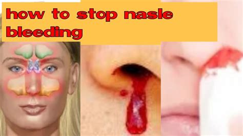 Nose Bleed Cause And Prevention Nasal Bleeding Irha Informative