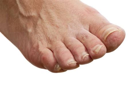 Itchy Feet Causes And Cures