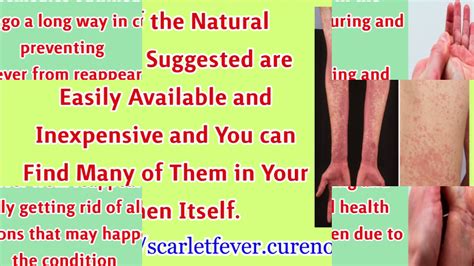 Treating Scarlet Fever And Pain Relief Natural Methods Youtube