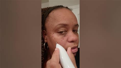 Dpn Treatment Part 2 Skin Tag Removal Read Description Youtube
