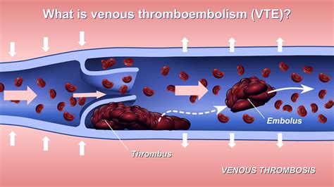Understanding And Diagnosing Venous Thromboembolism Vte Youtube