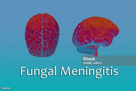 Background Of Fungal Meningitismeningitis Symptomsbacterial Meningitis