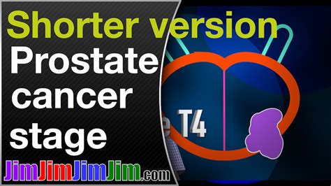 Prostate Cancer Stage In Advanced Prostate Cancer Youtube