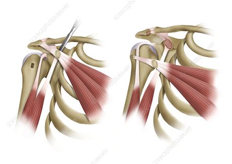 Shoulder Muscles Surgery Illustration Stock Image C0473230