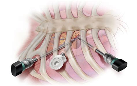 Heart Surgery Types Open Bypass Ablation Heart Valve Surgery