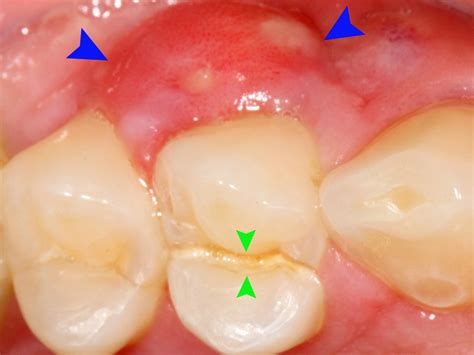 Why Are My Gums Swollen Behind My Teeth Teethwalls