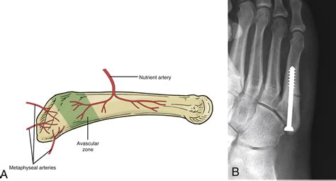 Open Reduction And Internal Fixation Of Proximal Fifth Metatarsal