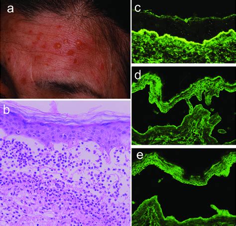 Findings For Skin Lesions At Bullous Disease Stage A Clinical