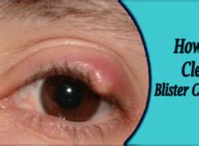 The lesion you describe is probably a nevus(mole). Home Remedies for Eyelids Archives - Eyelids Lift Blog