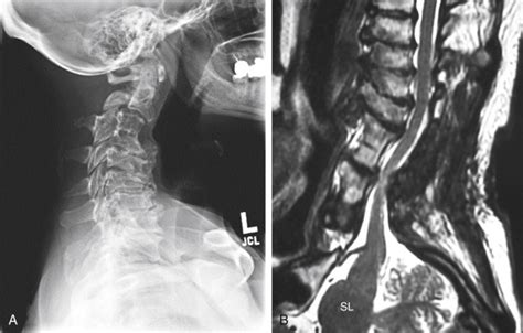 Osteotomies Of The Cervical Spine Musculoskeletal Key