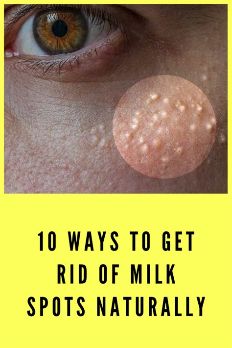 10 Ways To Get Rid Of Milk Spots Naturally Skin Bumps Whiter Skin Spots