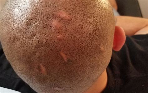Before And After Dermimatch Hair Clinic Scalp Micropigmentation