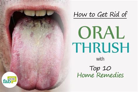 How To Get Rid Of Oral Thrush With Top 10 Home Remedies Remedies For Dry Mouth Tongue Health