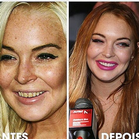 Doctor Ml On Instagram “before And After Dentist Beautiful Work Lindsay Lohan