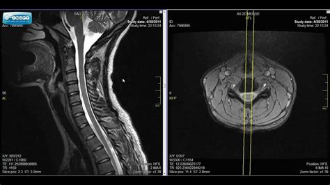 Normal Cervical Spine Mri Explained Dr Jeffrey P Johnson Hd Youtube