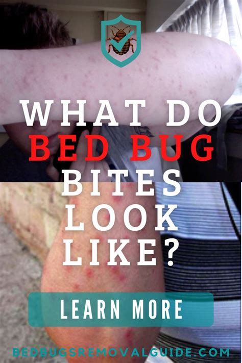 What Do Bed Bug Bites Look Like Bed Bug Bites Bed Bug Bites