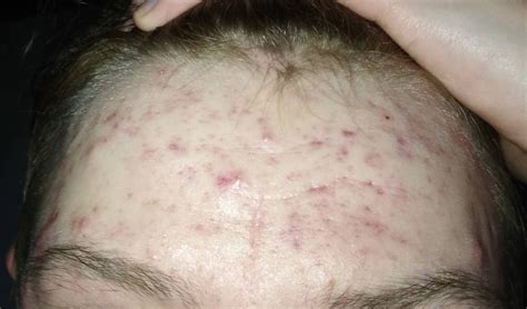 The drying lotion is also perfect for cystic acne, thanks to the addition of calamine lotion, which soothes the skin and reduces redness while you sleep, and salicylic acid, which penetrates deep into the pores, exfoliates skin cells and reduces sebum production. Wie werde ich diese Pickelmale los? (Pickel ...