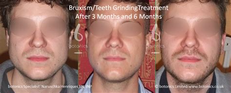 Bruxism Masseter Jaw Reduction With Botox Botonics