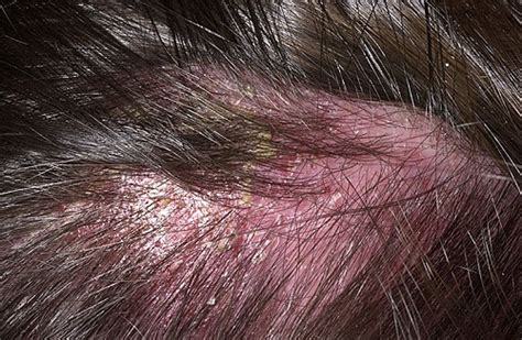 Seborrheic Dermatitis On Scalp Natural Skin Care Solution